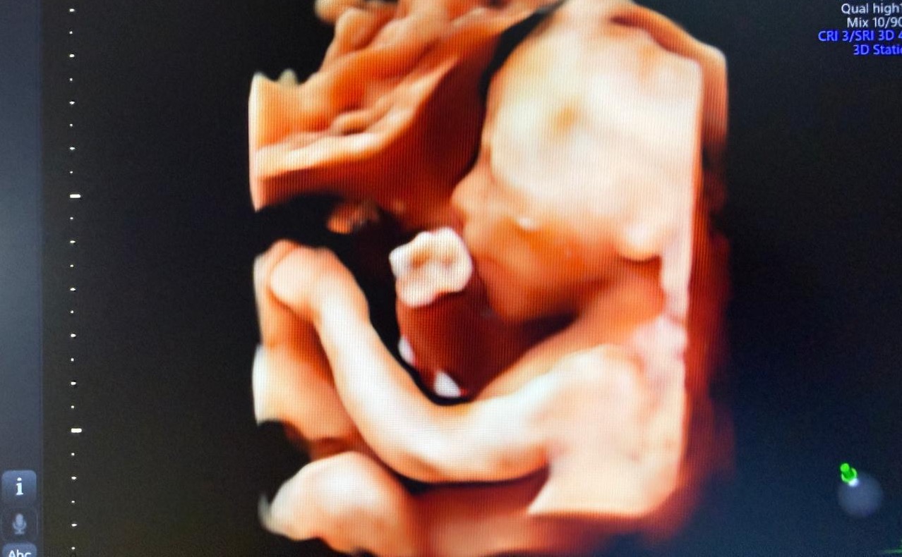 Ultrasonido 4D mostrando el rostro y cuerpo del bebé